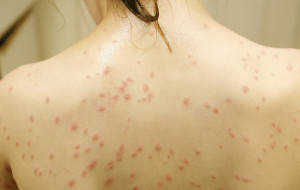 Swimmer's Itch spots often look like red small dots that spread on the areas that was touched by the lake water. submitted photo 